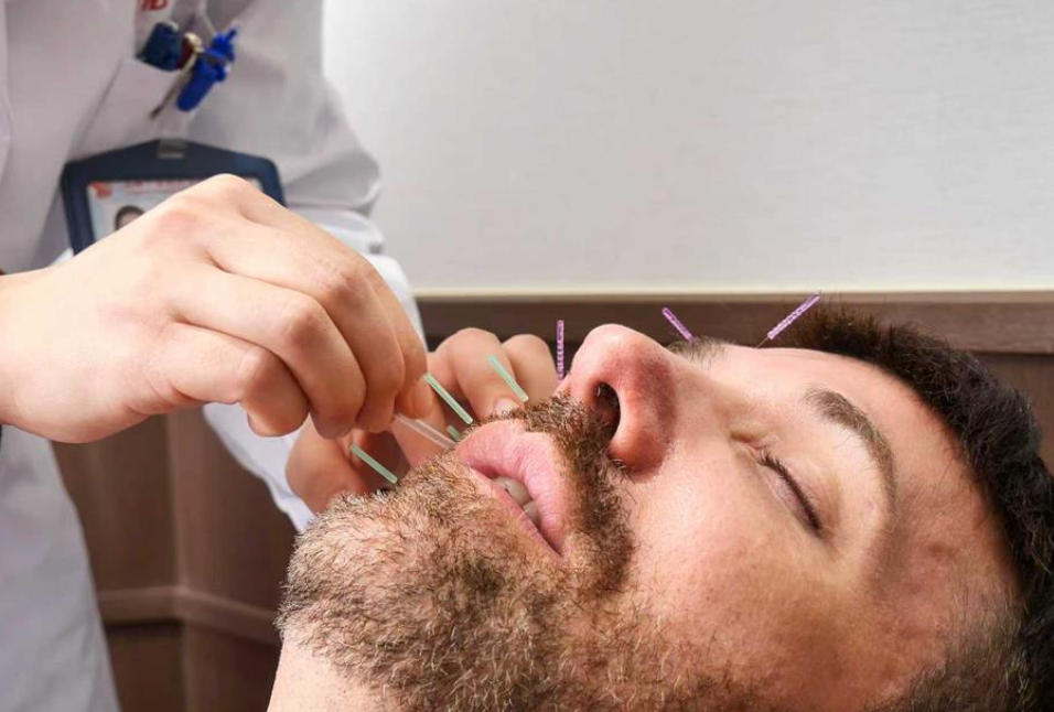 Cosmetic Acupuncture | TCM’s Aesthetic Evolution